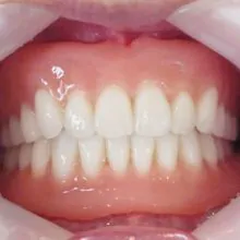 No.26「BPSデンチャーは本当に精密な義歯でした。」（80代　男性　千葉県）