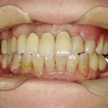 No.59「20年ぶりの歯医者さん。長い間、放置した歯が綺麗に治り満足です。」（50代 女性）