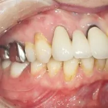 No.25「ウェルデンツ義歯は軽くてしなやかな感じです。」（50代　女性　千葉県）