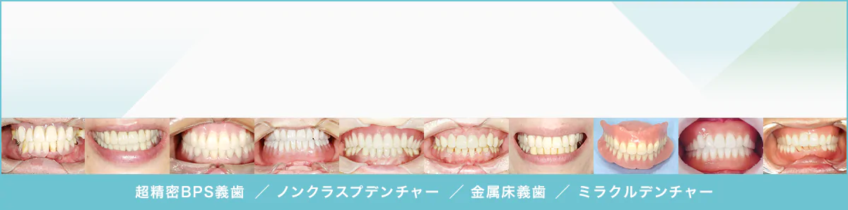 当院の入れ歯の症例はこちら 現在７０症例を掲載中（毎月更新中）超精密BPS義歯／ノンクラスプデンチャー／金属床義歯／ミラクルデンチャー
