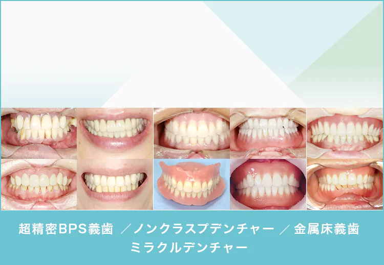 当院の入れ歯の症例はこちら 現在７０症例を掲載中（毎月更新中）超精密BPS義歯／ノンクラスプデンチャー／金属床義歯／ミラクルデンチャー