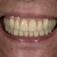 No.69「院長先生に作って頂いた入れ歯は、調整もしっかりやってもらってありがたいです」(60代　男性)